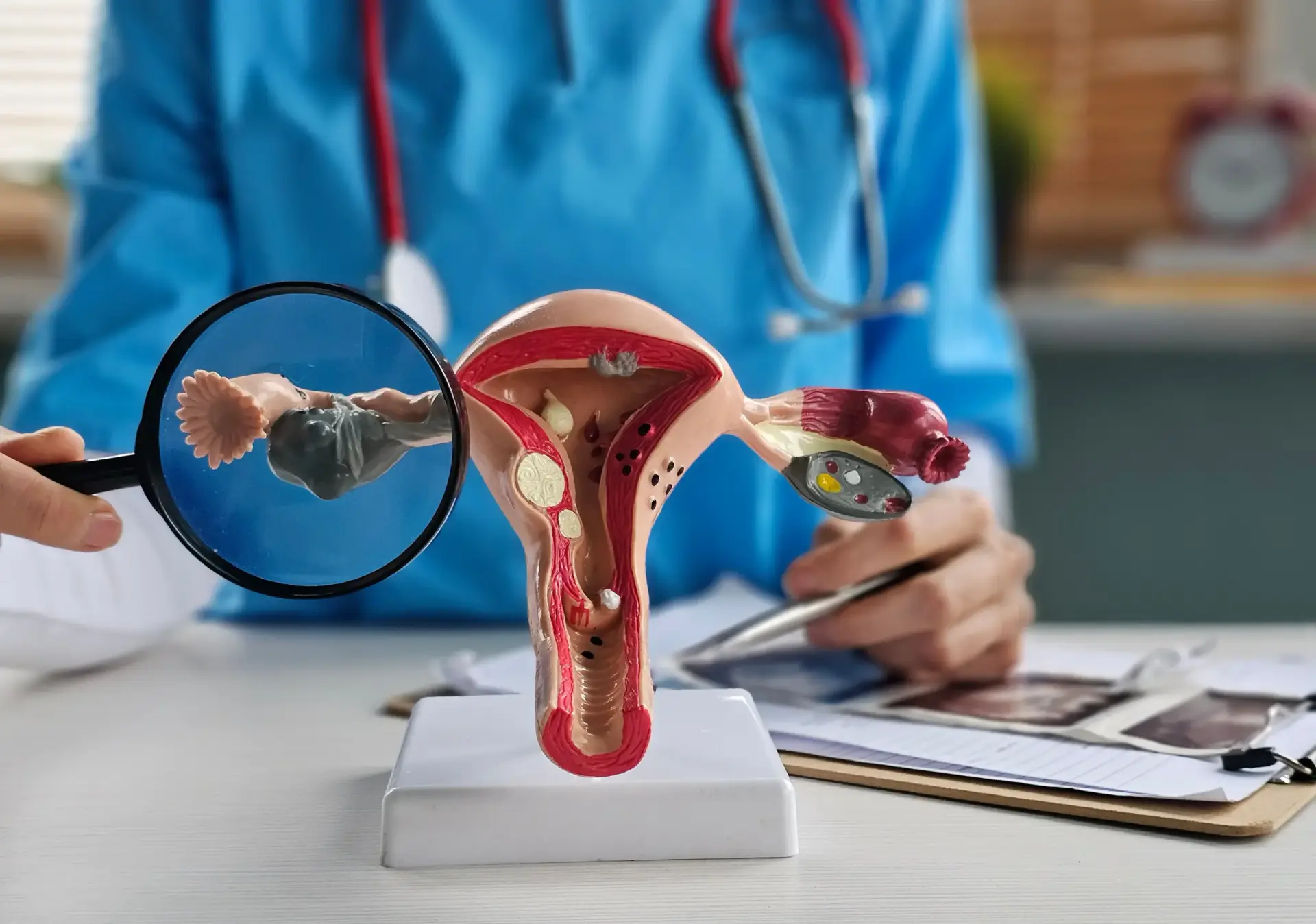 Endometrioza